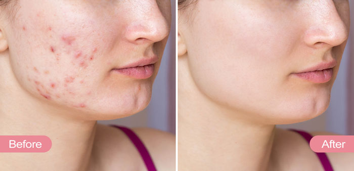 remove acne scars