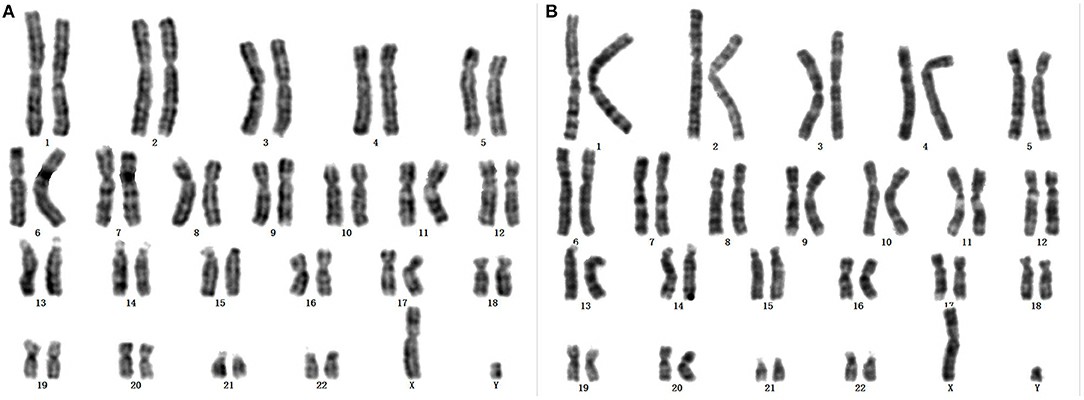 Karyotype Analysis in Rare Disease
