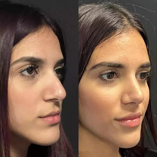 How the Best Doctors in Dubai Use 3D Imaging for Rhinoplasty Planning